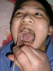 2009 - So sah der Zahnstatus bei den meisten Kindern aus